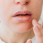 Bibir Kering Berkepanjangan? Waspadai Gangguan Sistem Imun!