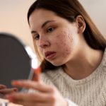 Imunitas Lemah? Ini Cara Sistem Imun Mempengaruhi Jerawat Hormonal pada Wanita!